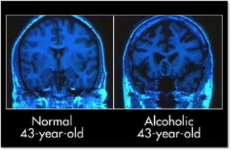 alcoholic-brain